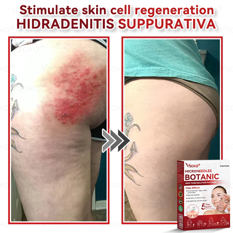 🔥 Dernière place disponible ! ⚡ Profitez de 30 % de réduction — offre limitée !𝑉𝑠𝑜𝑥𝑎® 𝑀𝑖𝑐𝑟𝑜-𝑎𝑖𝑔𝑢𝑖𝑙𝑙𝑒𝑠 𝐵𝑜𝑡𝑎𝑛𝑖𝑞𝑢𝑒 𝑃𝑒𝑎𝑢 É𝑡𝑖𝑞𝑢𝑒𝑡𝑡𝑒𝑠 𝑆𝑜𝑙𝑢𝑡𝑖𝑜𝑛 𝑃𝑎𝑡𝑐ℎ𝑠-𝐹𝑎𝑏𝑟𝑖𝑞𝑢é 𝑒𝑛 𝐹𝑟𝑎𝑛𝑐𝑒