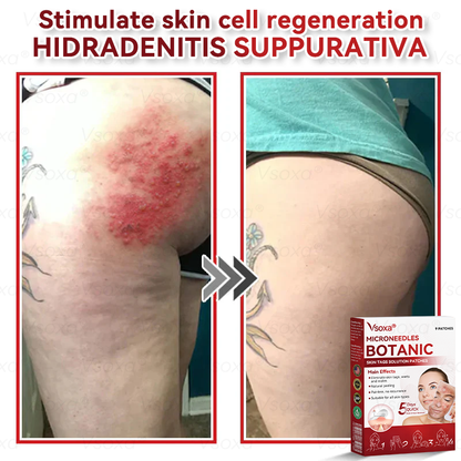 🔥 Dernière place disponible ! ⚡ Profitez de 30 % de réduction — offre limitée !𝑉𝑠𝑜𝑥𝑎® 𝑀𝑖𝑐𝑟𝑜-𝑎𝑖𝑔𝑢𝑖𝑙𝑙𝑒𝑠 𝐵𝑜𝑡𝑎𝑛𝑖𝑞𝑢𝑒 𝑃𝑒𝑎𝑢 É𝑡𝑖𝑞𝑢𝑒𝑡𝑡𝑒𝑠 𝑆𝑜𝑙𝑢𝑡𝑖𝑜𝑛 𝑃𝑎𝑡𝑐ℎ𝑠-𝐹𝑎𝑏𝑟𝑖𝑞𝑢é 𝑒𝑛 𝐹𝑟𝑎𝑛𝑐𝑒